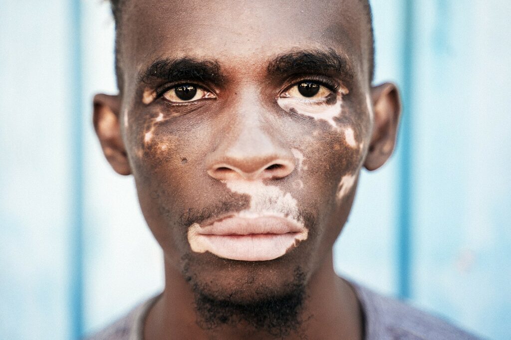 Portrait Of A Brown Skin Man With Vitiligo