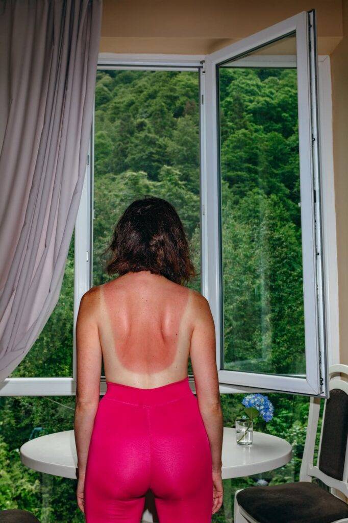a girl with her back badly burned in the sun looks out the window with a beautiful view fresh from moisture. Wrong tan on vacation and trip.