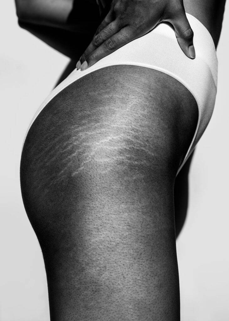 Black and white picture of the stretch marks in the upper thigh of an anonymous black woman in white lingerie.