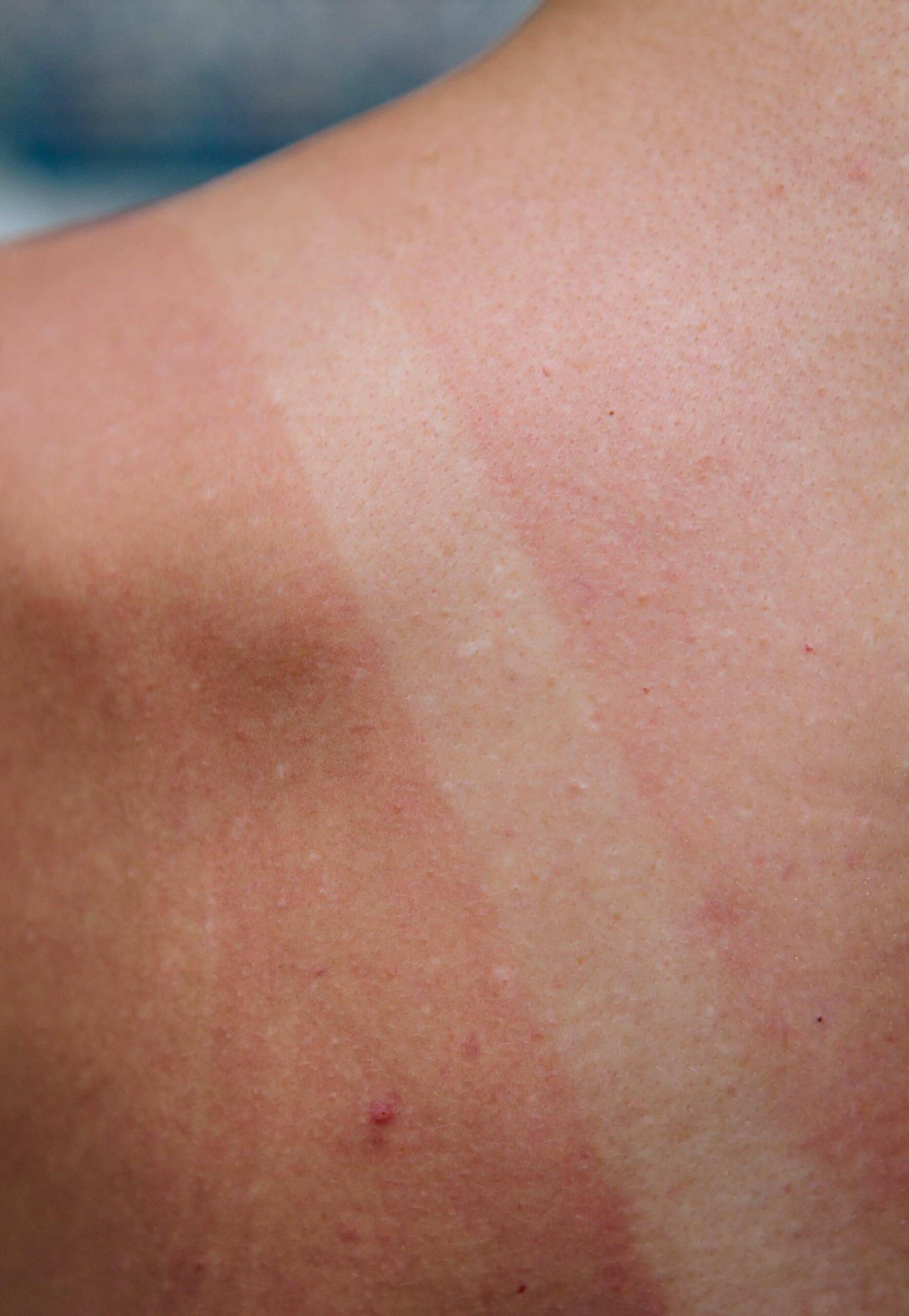 A womans sun burned back, showing the shape of her absent swimming costume, where she hasn't burnt. This is a real accidental incidence of sun burn on a fair skinned middle aged woman through excessive sun exposure.